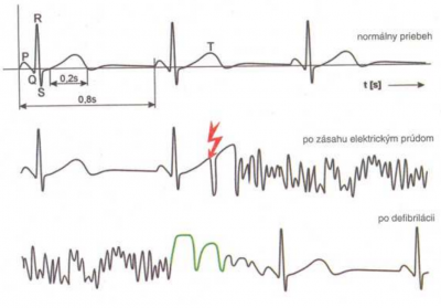 Elektrokardiogram (EKG) srdcovej činnosti 5 (priebeh el. poľa srdca - potenciál cca 1 mV)